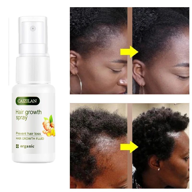 

Natural Ginger Hair Growth Loss Repair Tonic Oil Care Nourishing Hydrating Hair Care Men Women 20ml