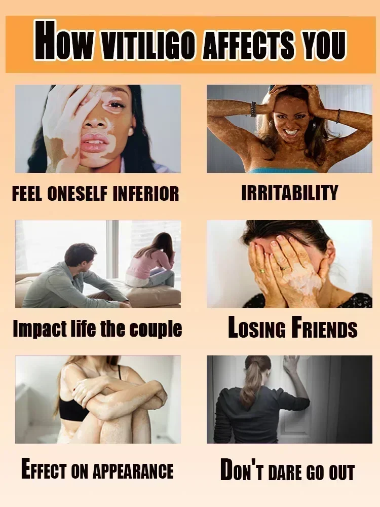 ГОРЯЧАЯ ПРОДАЖА лечение витилиго облегчение derma кожи успокаивающая удаление