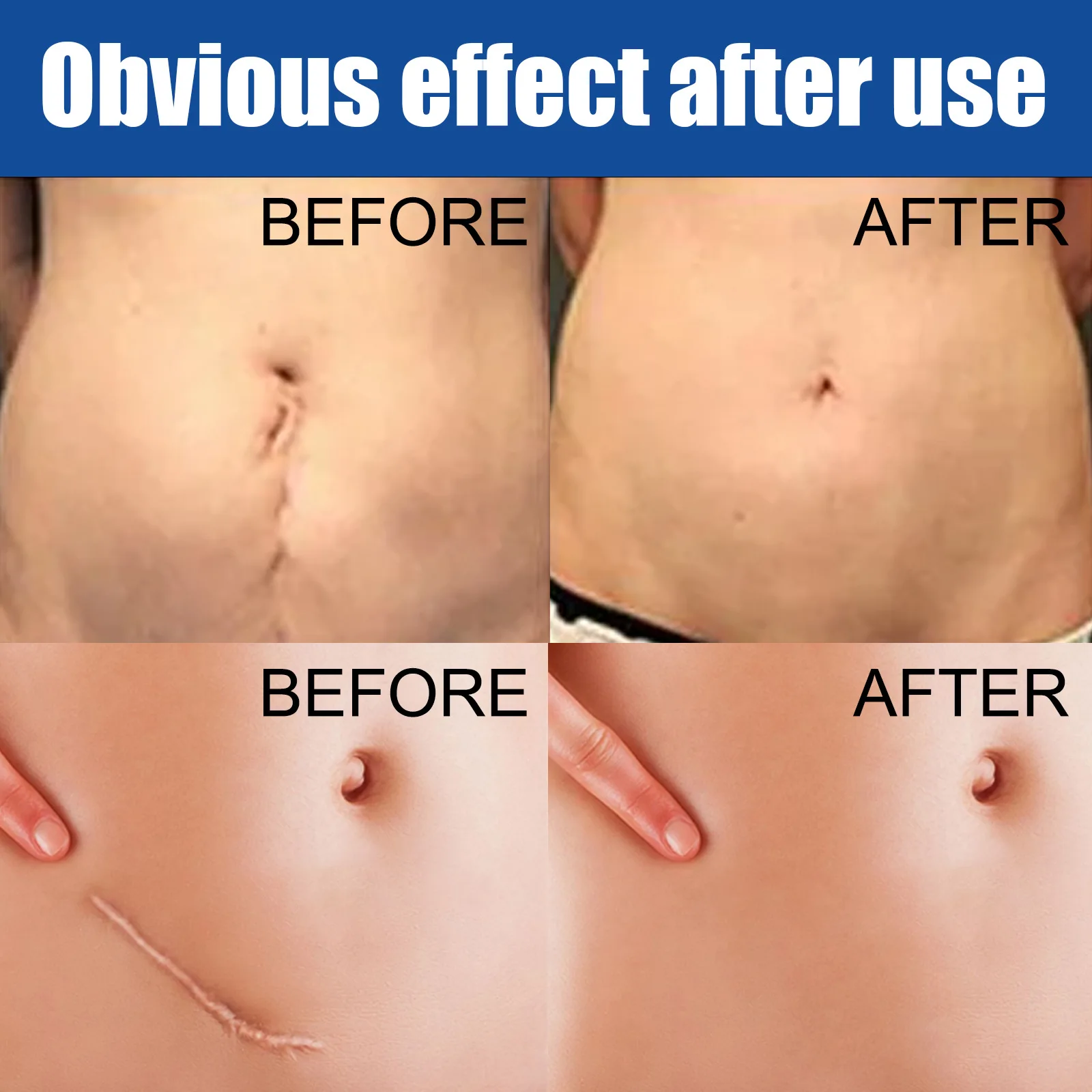 Крем для восстановления шрамов из десалта ожогов старых следов от акне лечения