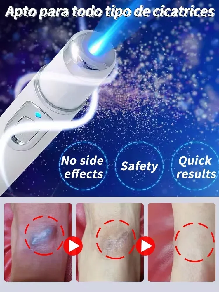 Лазерная терапия Keloid scAR