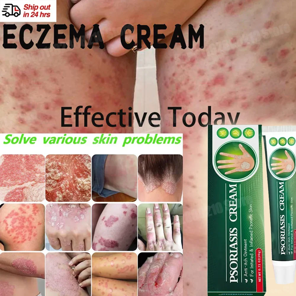 Натуральный крем от псориаза и экзмы работает действительно хорошо дерматита