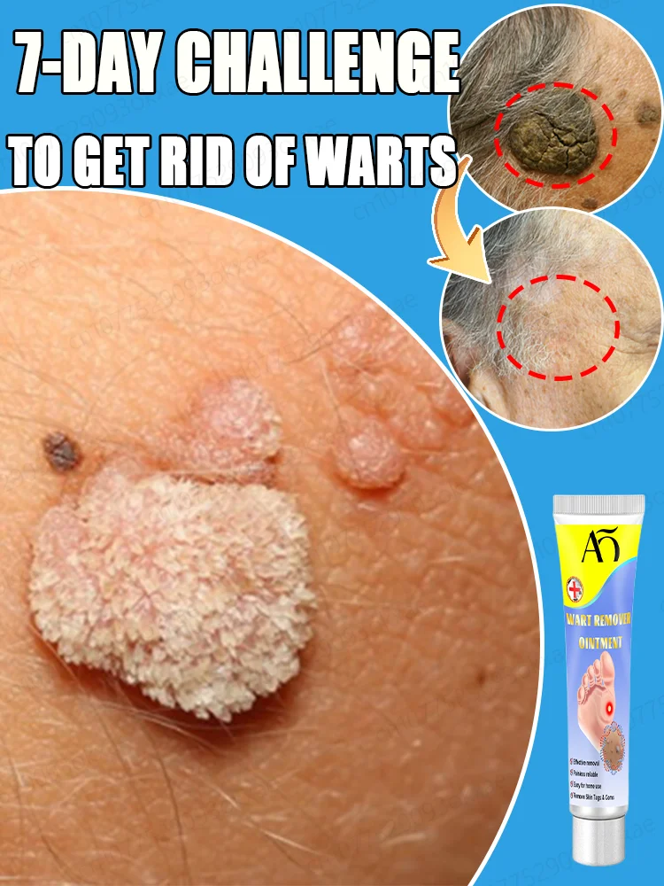 Попрощайтесь с бородавками и получите гладкую кожу без бородавок