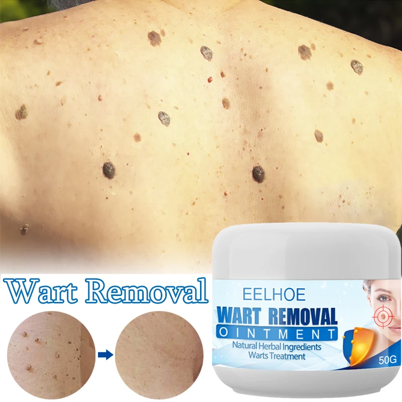 

Painless Natura Wart Removal Cream Treatment Skin Neck Armpits Genitals Flat Warts Remover Calluses Feet Ointment Body Care