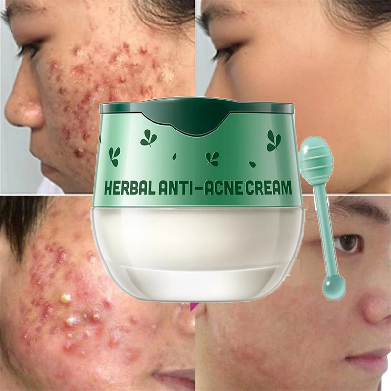 

Herbal Acne Removal Cream Treatment Acne Scar Shrink Pores Oil Control Whitening Face Gel Moisturizing Nourish Smooth Skin Care