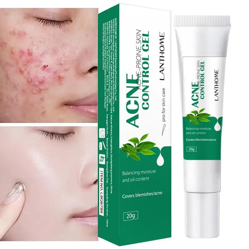 

Pimple Remover Zit Gel Blemish Gel To Repair Pimple Marks And Moisturize Skin For Enlarged Pores Oily Skin Whitehead Blackhead