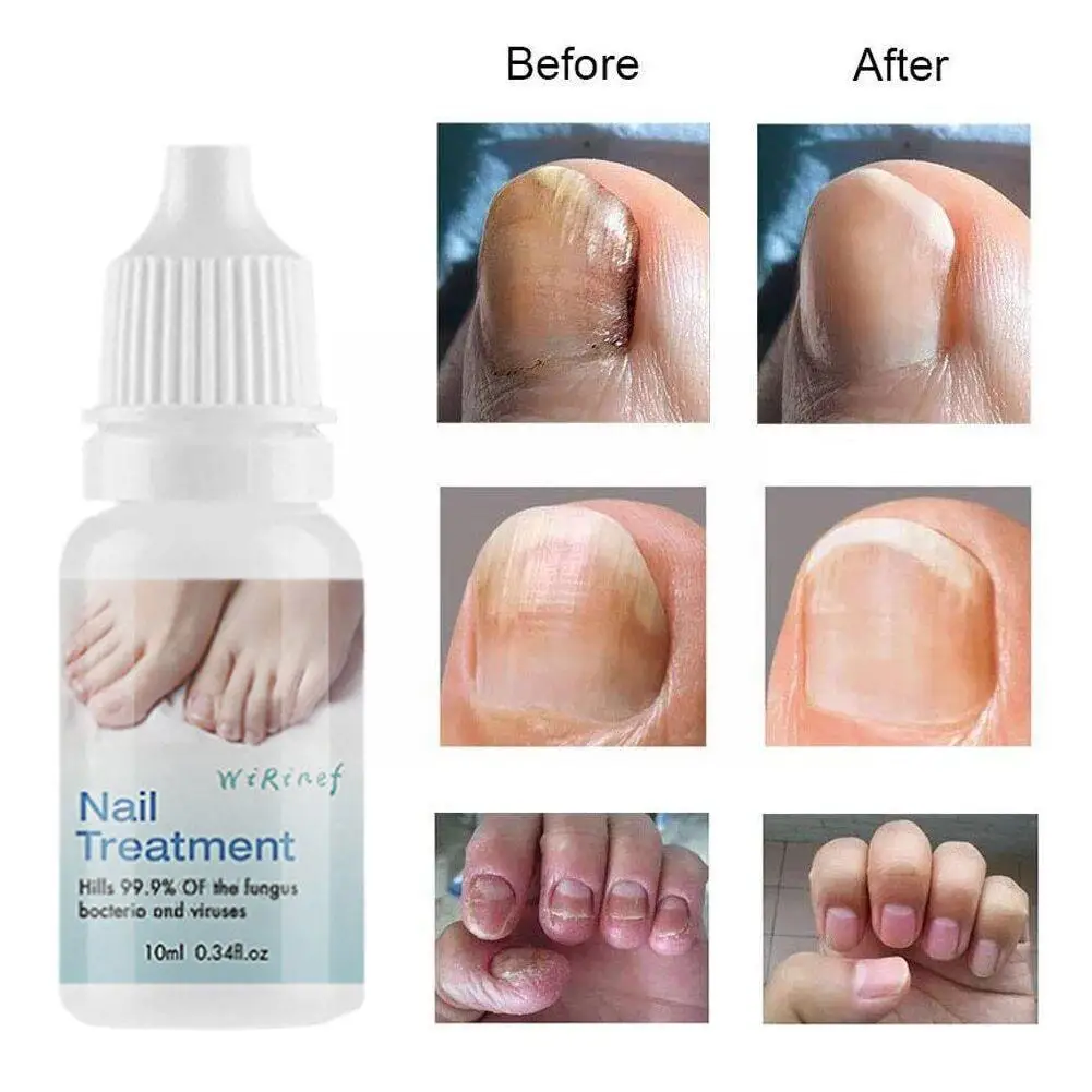 

10ML Nail Fungus Treatment Oil Foot Repair Essence Repair Restore Infection Oil Nail Removal Fungus Gel Toenail Anti Shine Y8W6