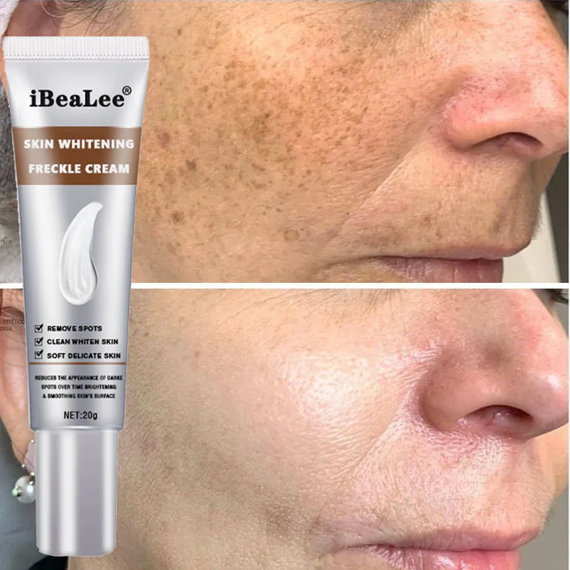 

Effective Whitening Freckle Cream Removal Acne Dark Spots Fade Melasma Melanin Pigment Corrector Moisturizing Brighten Skin Care