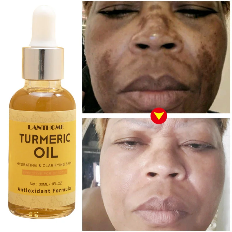 

Turmeric Oil Facial Whitening Dark Spot Remover Serum Acne Dark Patches Corrector Anti Aging Brighten Improve Roughness Skin