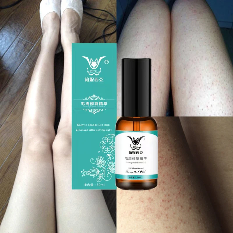 

Mint Treatment Body Ichthyosis Leg Keratosis Follicularis Cream Chicken Skin Natural Thigh Fish Scale Body Essential oil