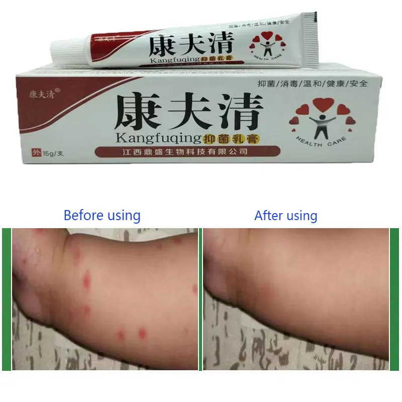 

Anti-pruritic Gel Mosquito Cream Children Adults Repellent Fast Itching Roll-on Gel Mosquito Bites Anti-Itching Swelling Cream