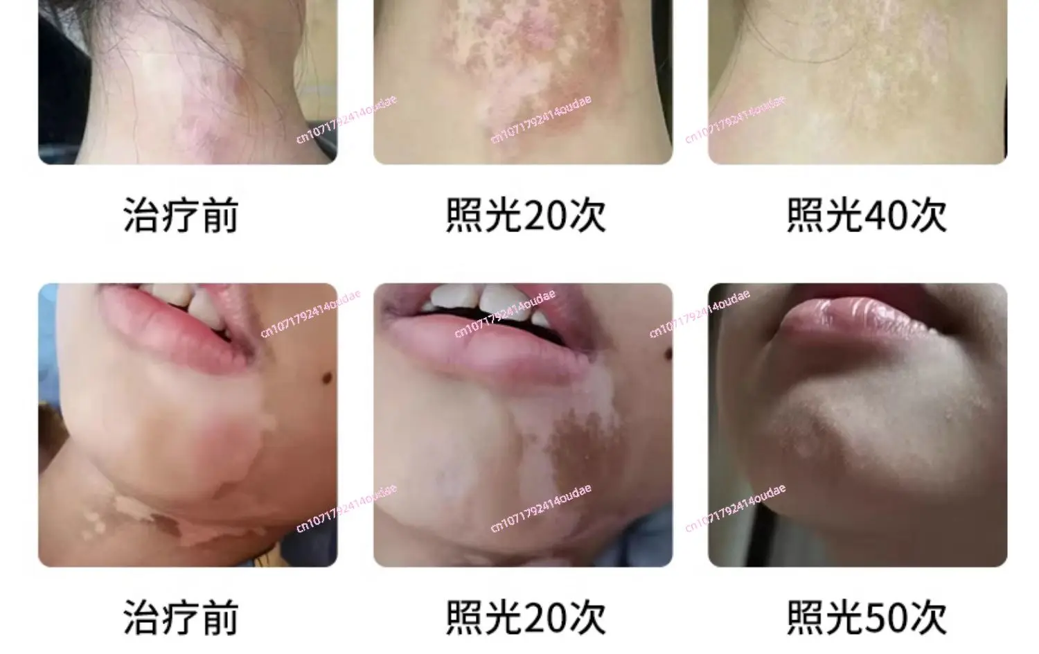 Медицинское устройство для фототерапии vitiligo домашнее лазерной терапии с