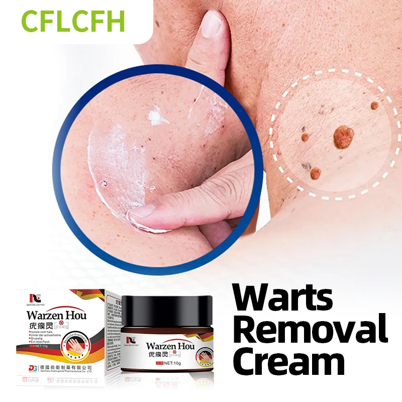 

Wart Remover Cream Skin Tag Mole Corns Treatment Ointment Flat Warts Calluses Removal Medicine German Secret Recipe