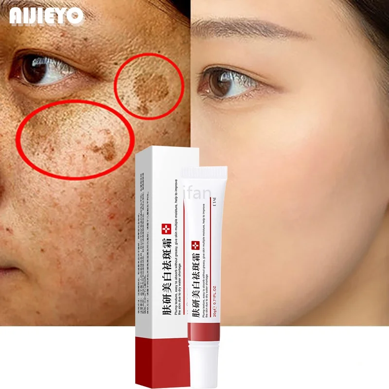 in stockWhitening Freckle Cream Remove Melasma Acne Spot Pigment Melanin Dark Spots Pigmentation Freckle Removal Cream Moisturiz