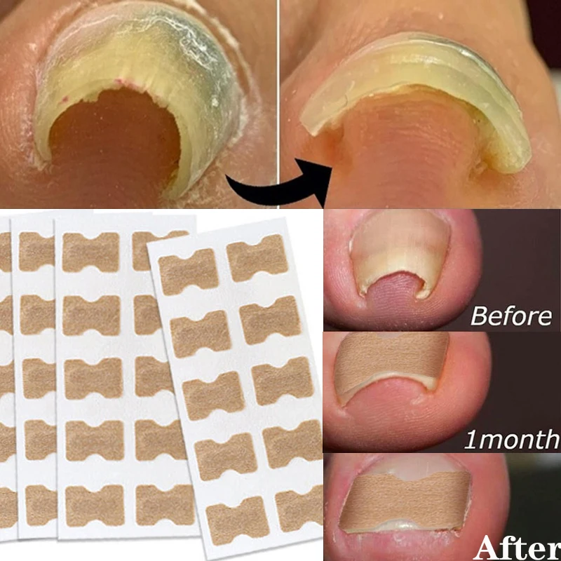 

5/10PC Nail Correction Sticker Ingrown Toenail Corrector Patches Waterproof Paronychia Treatment Recover Corrector Pedicure Tool