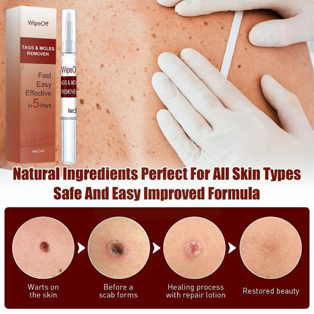 

1pc Warts Remover Liquid Skin Tag Remover Skin Tag Cream Liquid Wart Antibacterial Herbal Pen Treatment Ointment Remover E1W9