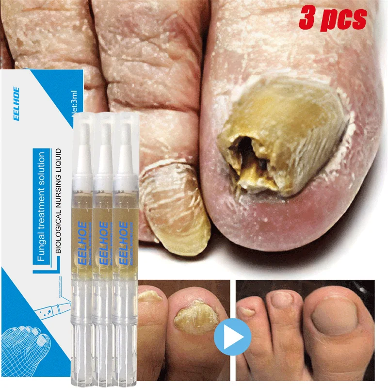 

3 шт., сыворотка для лечения грибка ногтей, против инфекции