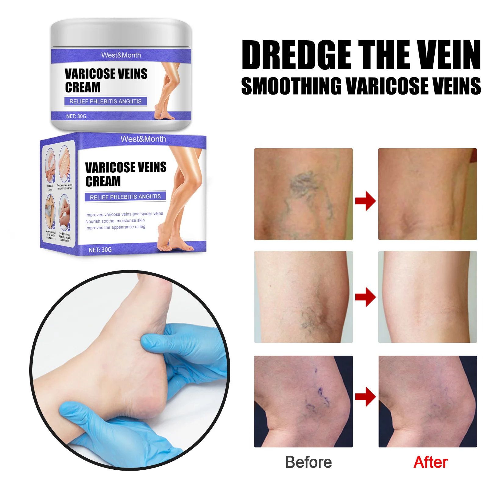 

2PCS Effective Varicose Veins Relief Cream Relieve Vasculitis Phlebitis Spider Pain Treatment Ointment Medical Plaster Body Care