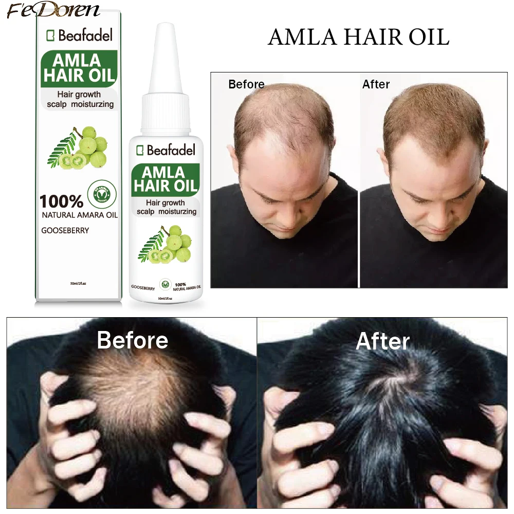 For Hair Growth India Gooseberry Hair Oil Anti Hair Loss Sca