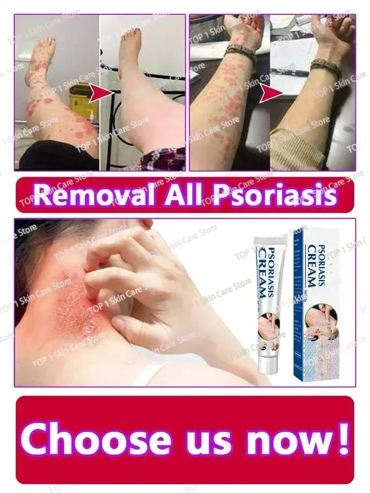 Натуральный растительный экстракт для удаления псориаза от дерматита