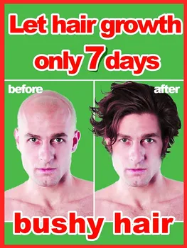 Crescimento rápido do cabelo Tratamento do folículo capilar Crescimento do cabelo Alopecia seborreica Linha do cabelo para cima Queda de cabelo pós-parto Calvície Queda de cabelo 1