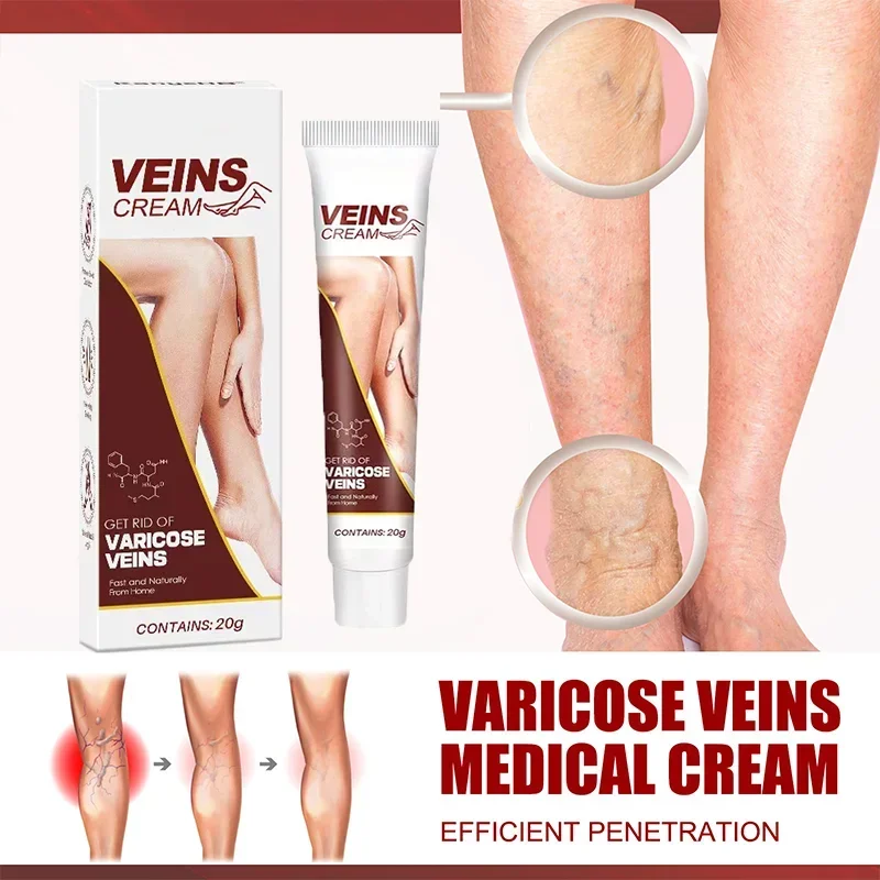 Varicose Vein Treatment Leg Health Ointment Effectively Removing Spider Veins2210