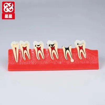 Caries Show model pathology teaching model tooth nerve Dental Materials free shipping