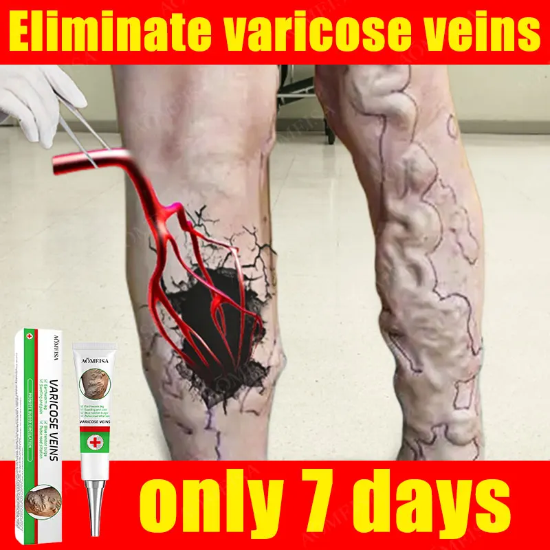 

Effective Varicose Vein Relief Cream Ointment For Varicose Veins To Relieve Vasculitis