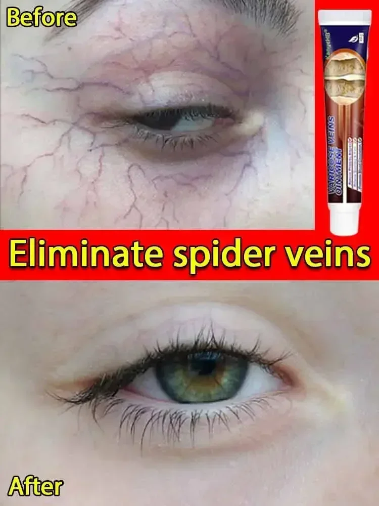 Фотоаппарат для лечения варикозного ангиита удаления отеков и боли в бедре