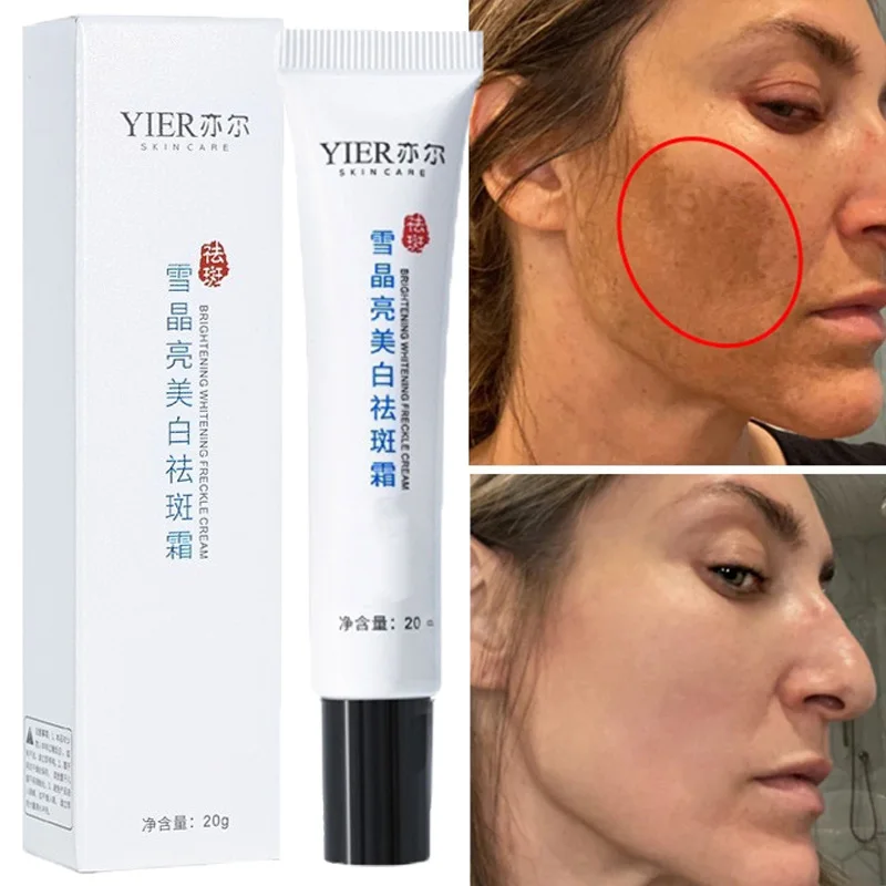 

Whitening Freckle Cream Remove Dark Spots Melasma Lighten Melanin Anti-Pigmentation Improve Dullness Fast Brighten Skin Care