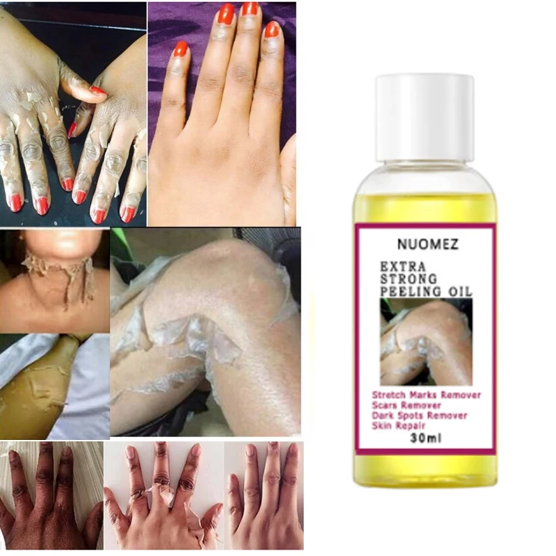 

30ml Extra Strong Yellow Peeling Oil Whitening Peeling Oil Lighten Elbows Knees Hands Melanin Even Skin Tone and Whiten Skin
