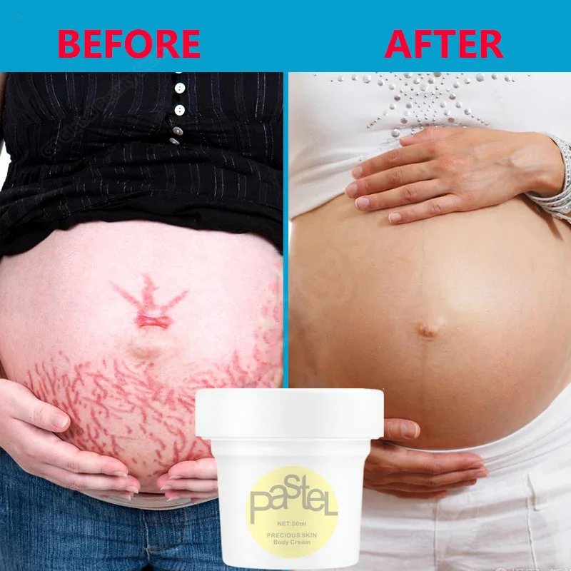 

Stretch Marks Permanent Removal Cream Maternity Pregnant Women Pregnancy Scar Skin Repair Anti-Winkle Firming Skin Body Care