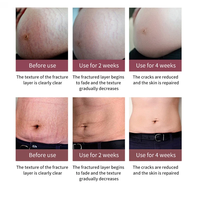 Крем-растяжка для беременных женщин антивозрастной крем ухода за кожей с