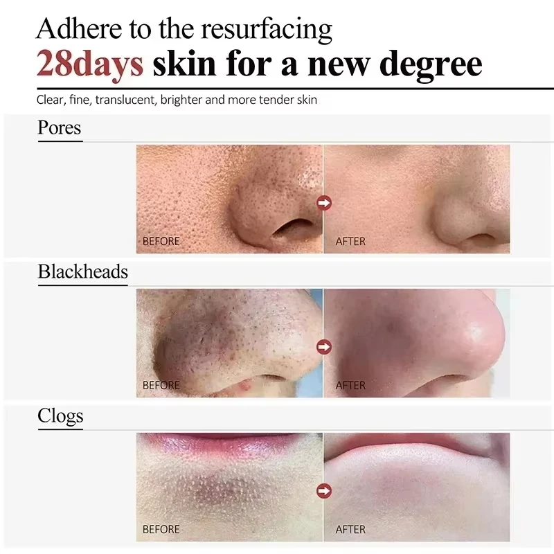 Крем для сужения пор с салициловой кислотой быстрое устранение больших удаление