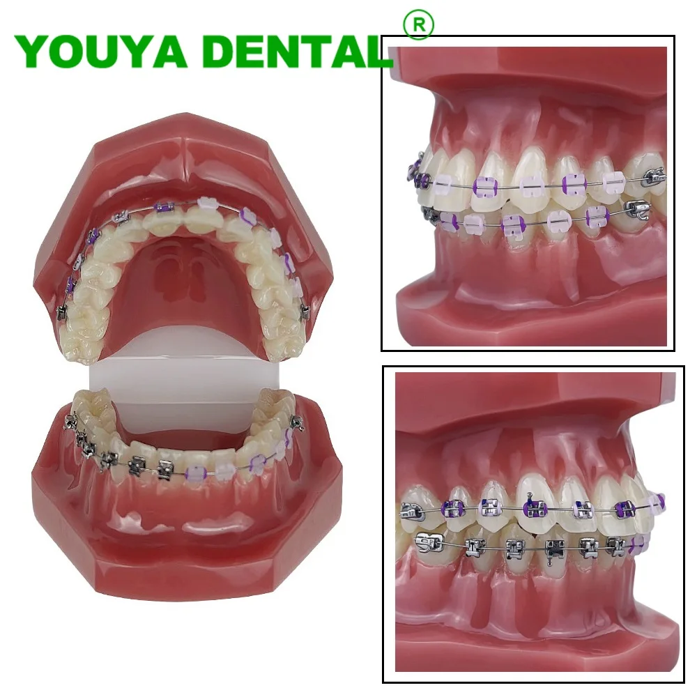 

Dental Orthodontic Teeth Model With Self Ligating Metal Metal Bracket Braces Arch Wire Ligature Ties Dentist Demonstration Tools