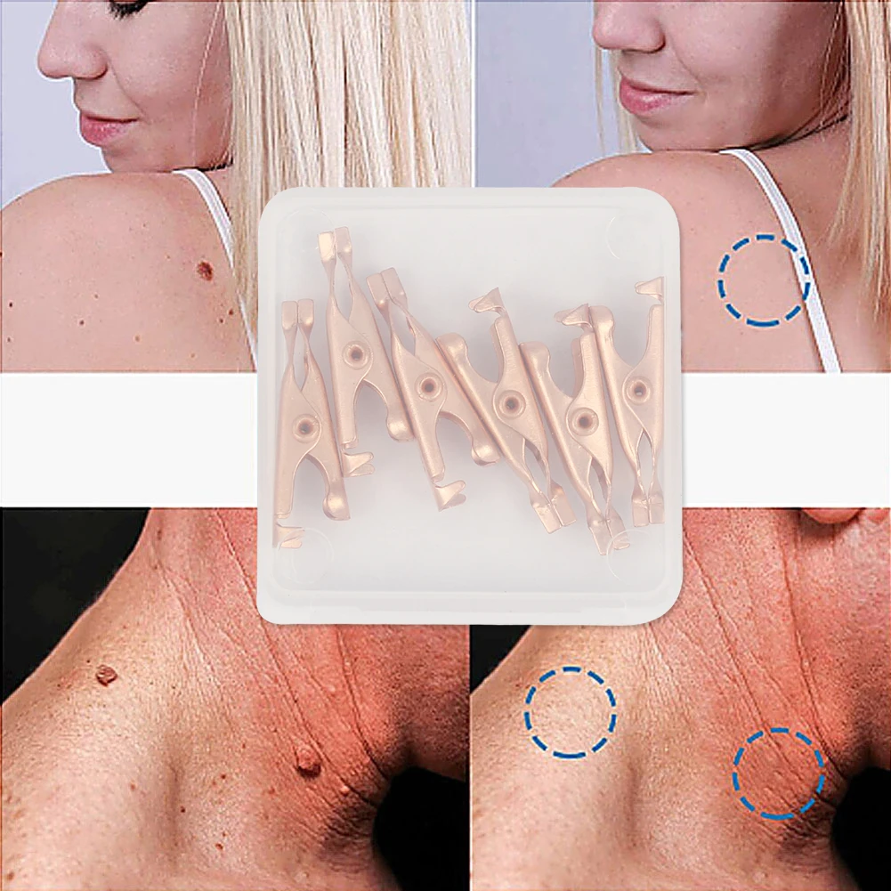 2/6 шт. безболезненная бирка для кожи клипсы удаления родинок бородавок лечение