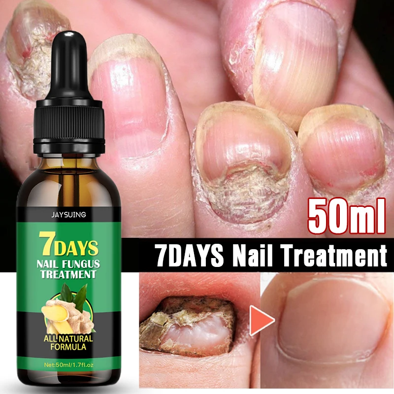 

7 Days Nail Fungus Treatment Serum Oil Toe Nail Fungus Removal Serum Repair Onychomycosis Anti-Infection Gel Care Products