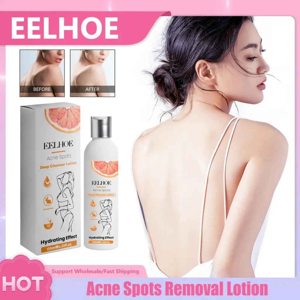 

Acne Spots Removal Cream Shrink Pores Fade Pigmentation Underarm Joints Whitening Nourishing Brighten Skin Body Bleaching Lotion