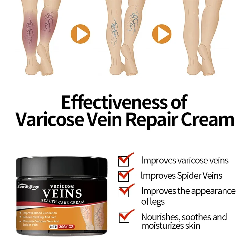 Крем для лечения варикозного расширения вен восстанавливает боль в ногах