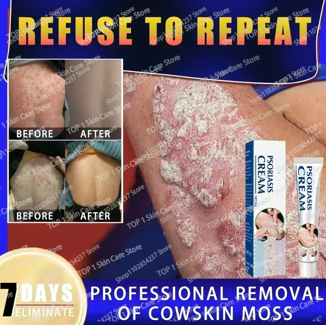 Улучшение здоровья при псориазе антибактериальное средство здоровье тела