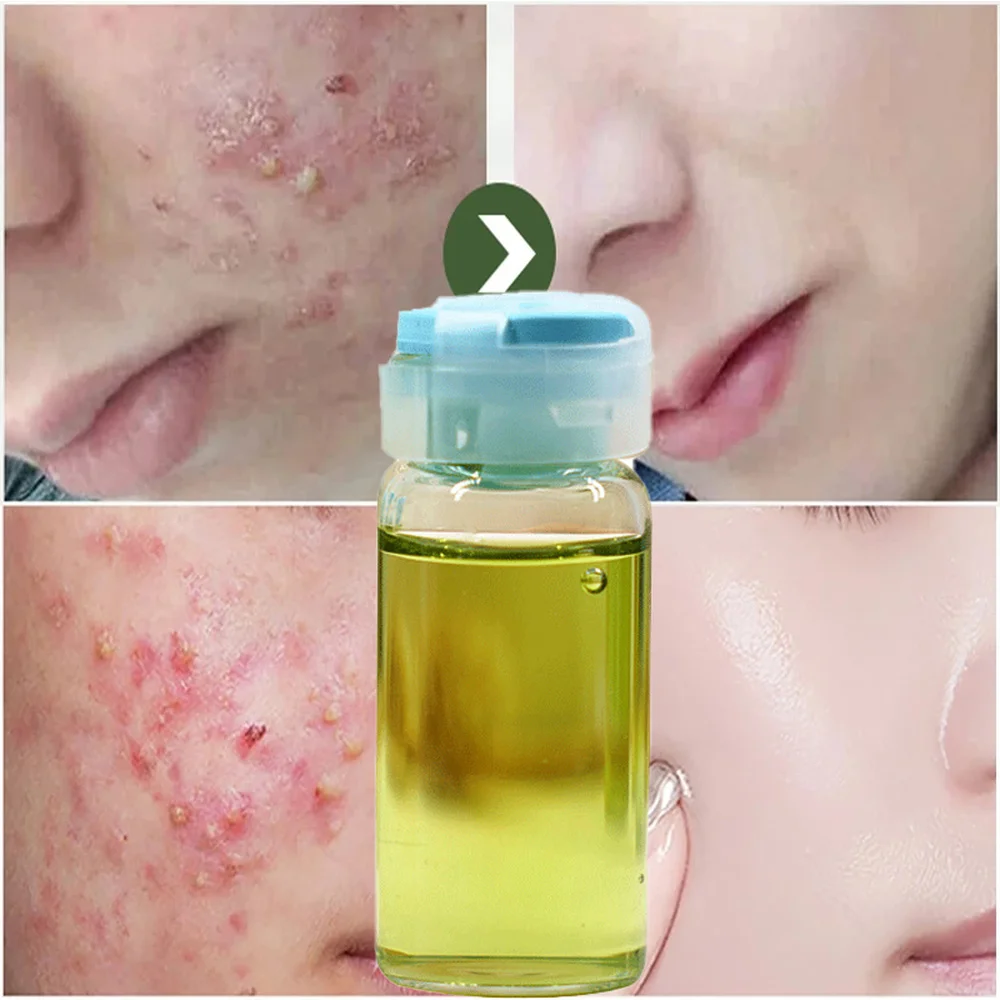 

10ml Effective Anti-acne Essence Oligopeptide Anti-acne Facial Essence Shrink Pores Balance Oil Control Oil Moisturizing Care