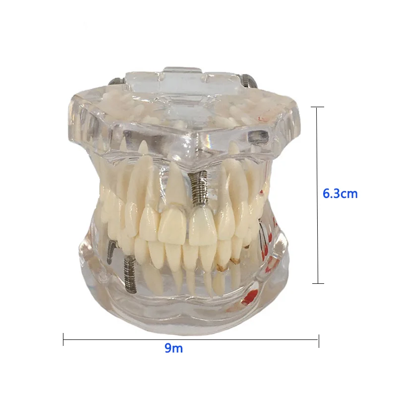 Мост для восстановления зубных имплантатов стоматологическое обучение