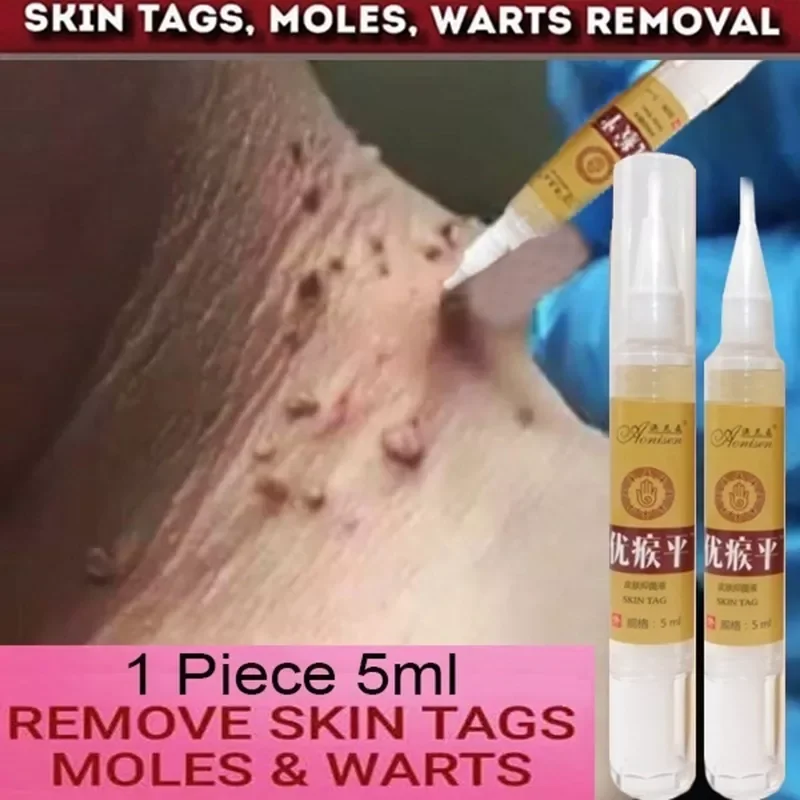 

Tag Remover Medical Against Moles 12 Hours Fast Removal Genital Wart Acne Spot Treatment Anti Foot Corn Skin Care Liquid