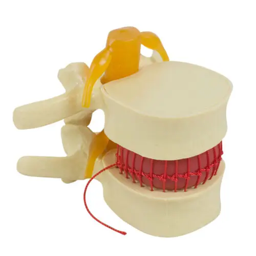 

1:1.5 Human Spine Lumbar Disc Herniation Model Spine Model
