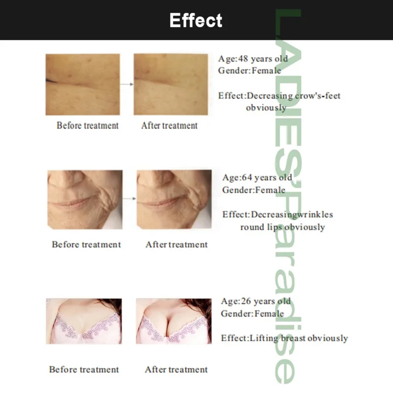 Биоэлектрическая стимуляция аппарат для подтяжки кожи лица холодный и Горячий