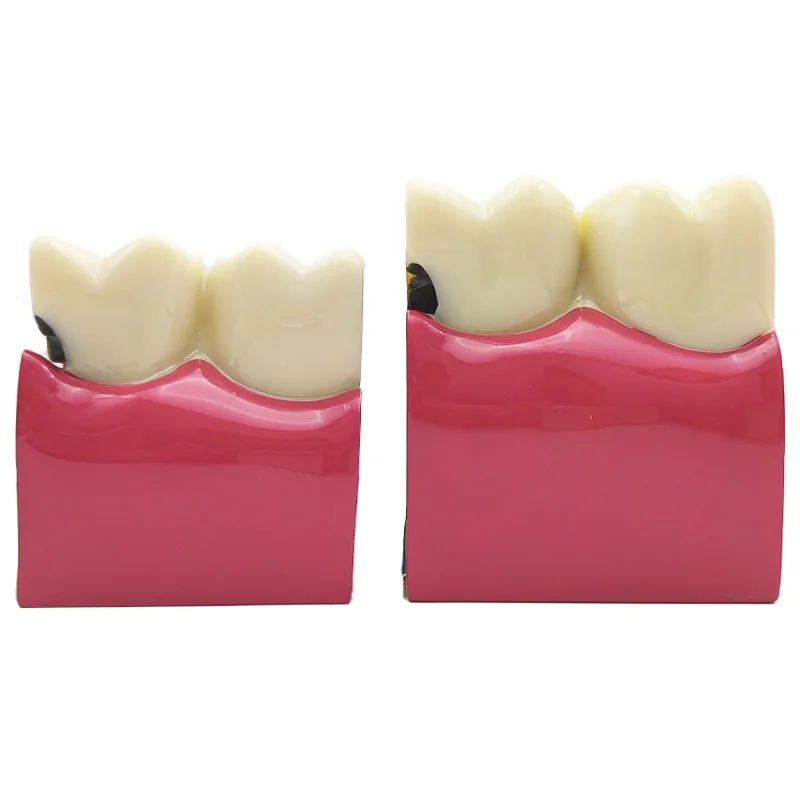 Модель кариеса Стоматологическая 6X 8X модель для сравнения обучающая общения