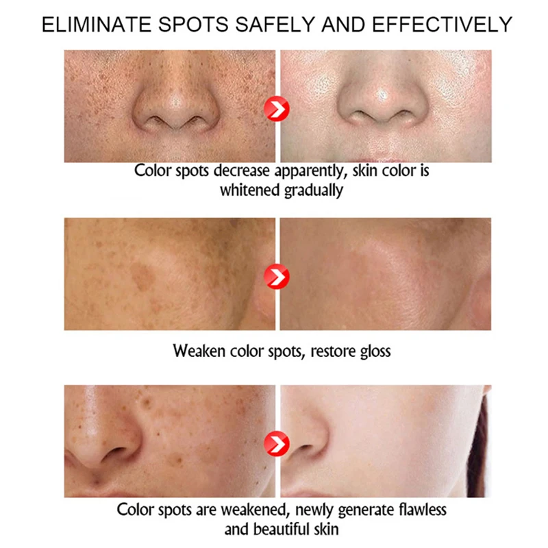 Ниацинамидный отбеливающий крем для лица темные пятна средство удаления