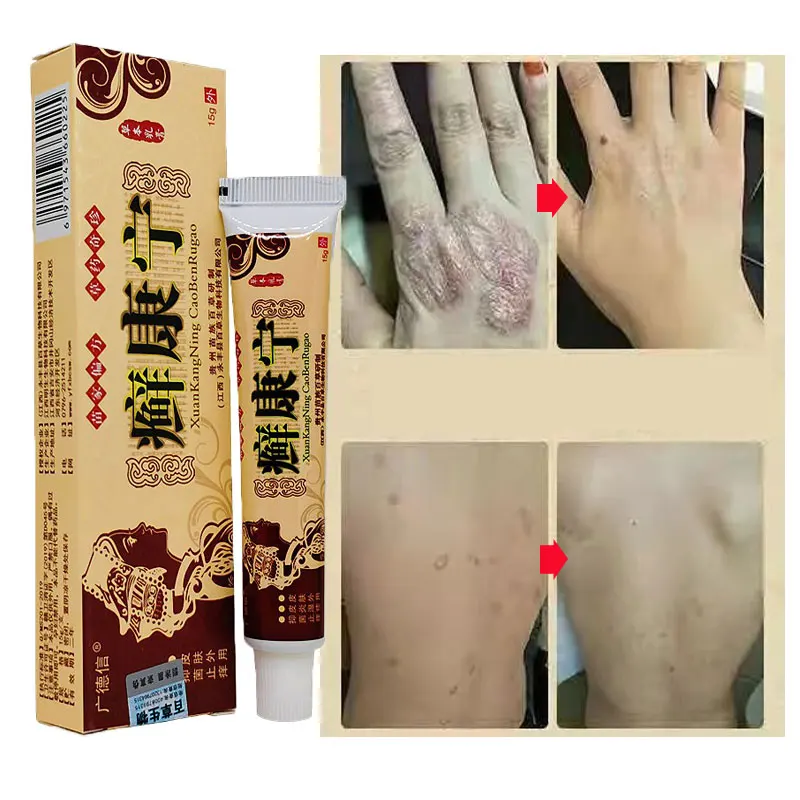 

Cowskin moss cream for dermatitis and eczema Psoriasis Ointment Skin dermatitis cream Anti-itch