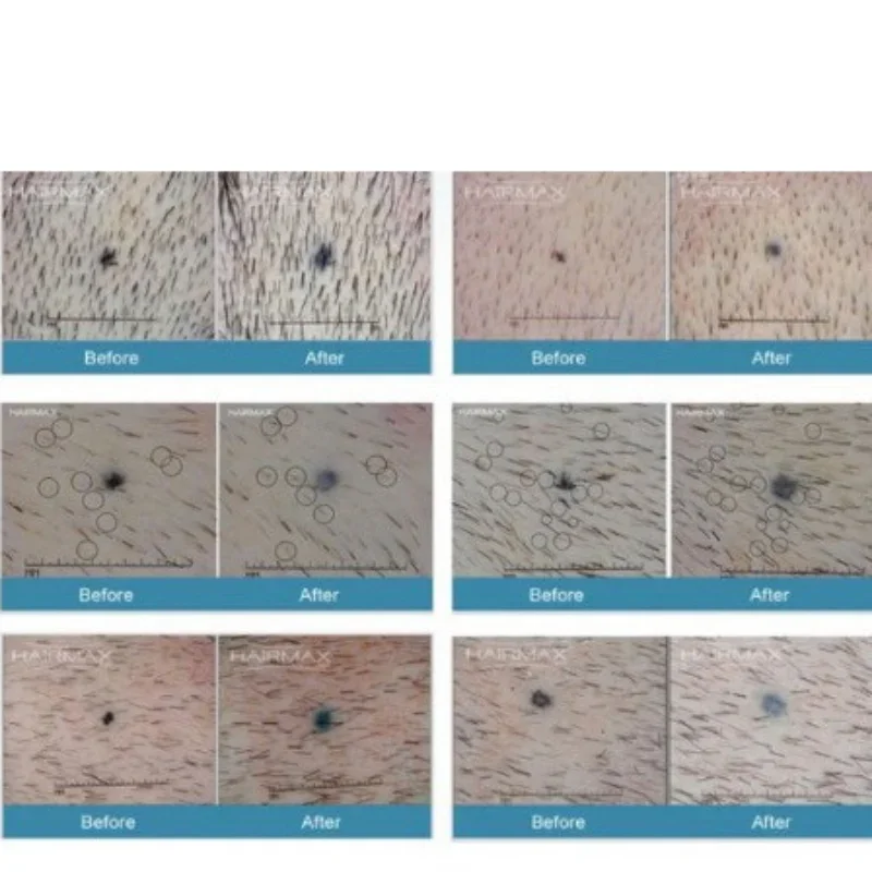 678 нм шлем для роста волос устройство против выпадения лечение способствующая