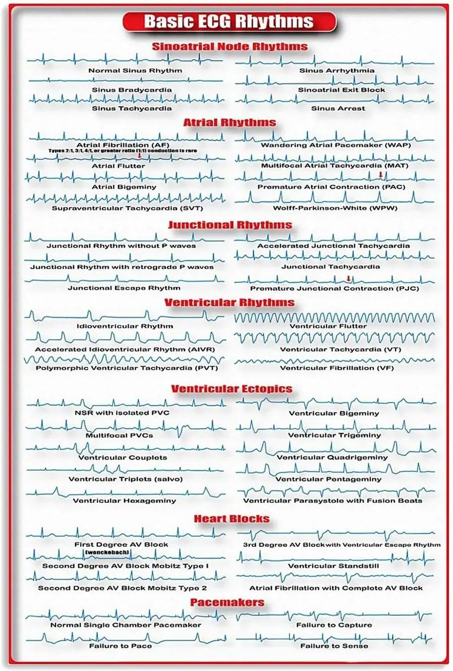 Bsc Ecg Rhythms nfogrphc Metl Sgn Crdology Study Gude Poster Crdologst Office Decor Doctor Hosptl Home Wll 16x24 nches