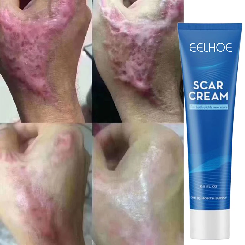 

Scar Removal Cream For Old Scars Eliminate Acne Scar Stretch Marks Permanent Injury Burn Scald Surgical Scar Removal Ointment20g